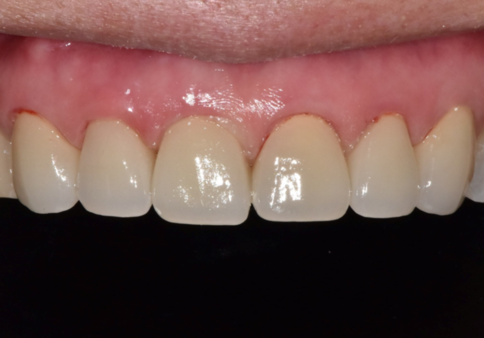 고덕동 앞니 보철, 브릿지와 싱글 크라운, 어떤 선택이 나에게 더 유리할까? 관련 이미지 10