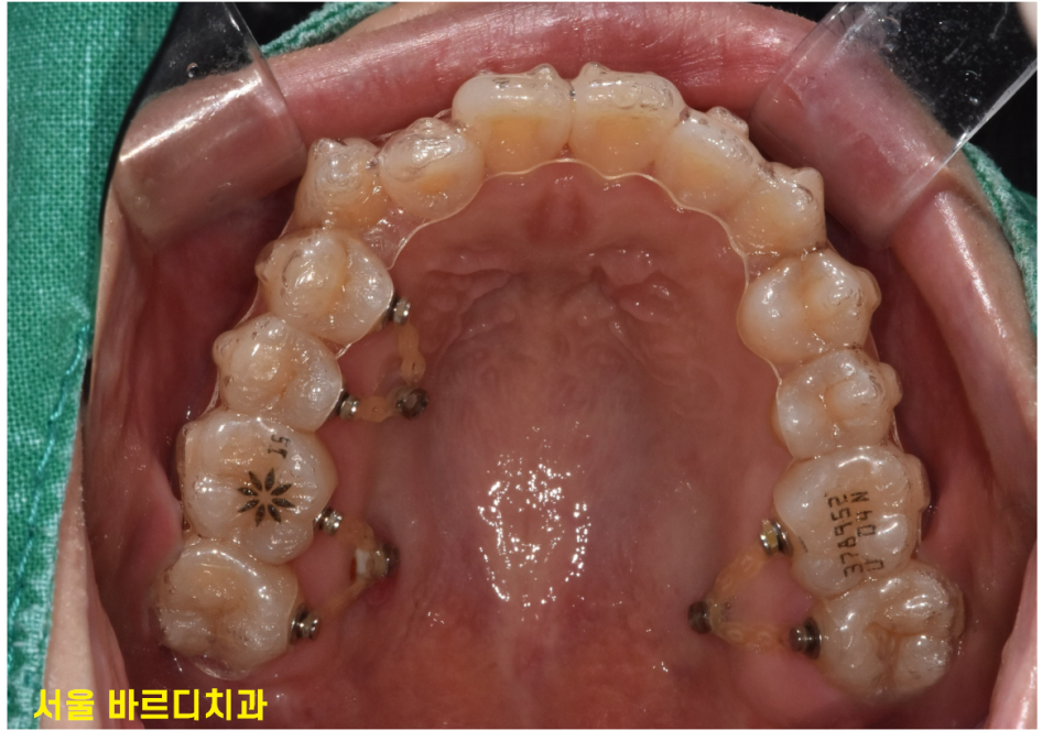 인비절라인 투명교정 오해 편하긴 하지만 치아를 움직이기에 관련 이미지 3