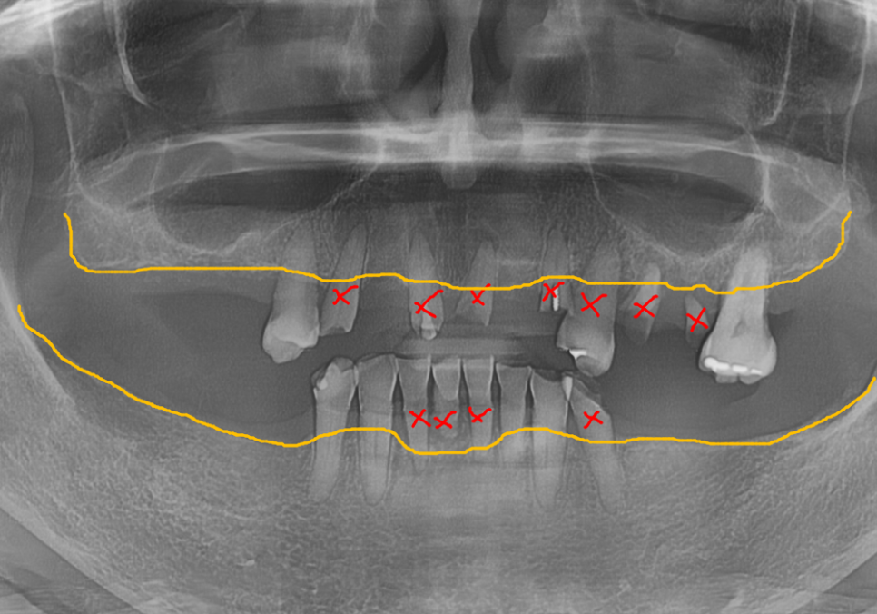 뿌리만 남은 치아, 그대로 두면 왜 위험할까요? 고덕동 전체 임플란트 재건 사례 관련 이미지 7