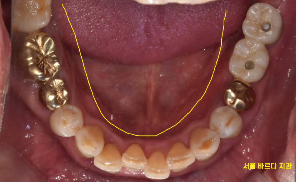 고덕동 치과 디지털 임플란트는 뭔가요? 뭐가 달라요? 관련 이미지 3