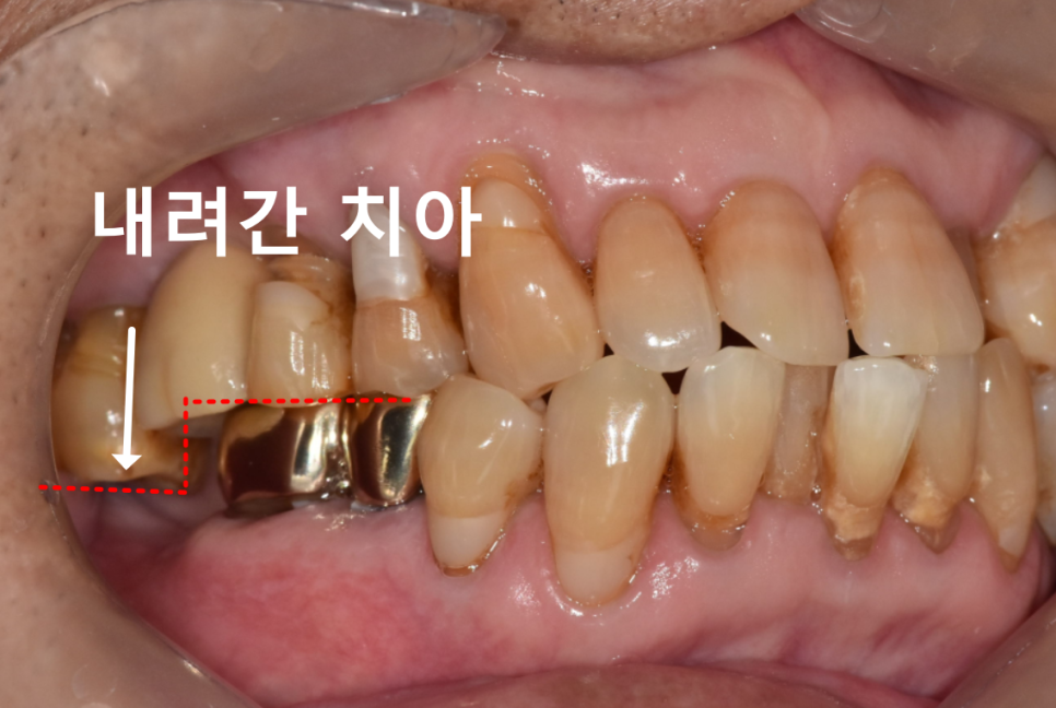 고덕동 20대 임플란트, 시기 놓치면 비용 2배 이상 듭니다. 관련 이미지 3