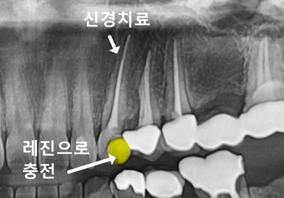 앞니가 검게 변색된 이유, 신경치료 후 꼭 크라운으로 씌워야 하는 걸까요? 관련 이미지 5