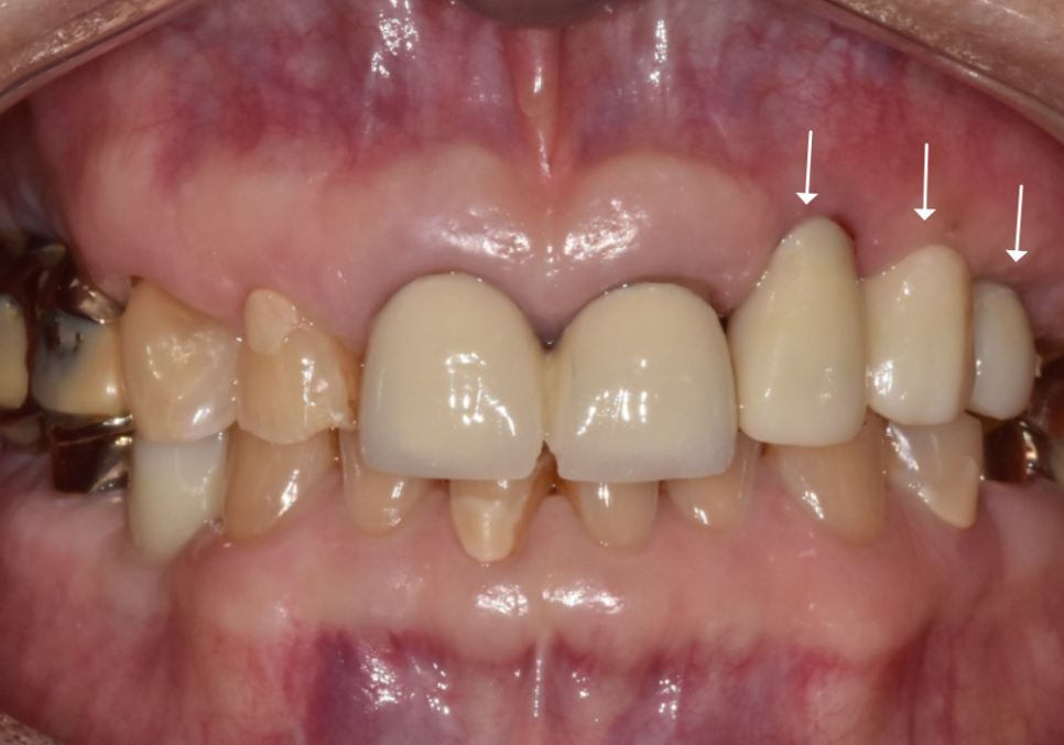 아스피린 복용 중인데 임플란트 수술, 가능할까요? 아스피린 얼마나 끊어야 하나요? 관련 이미지 10