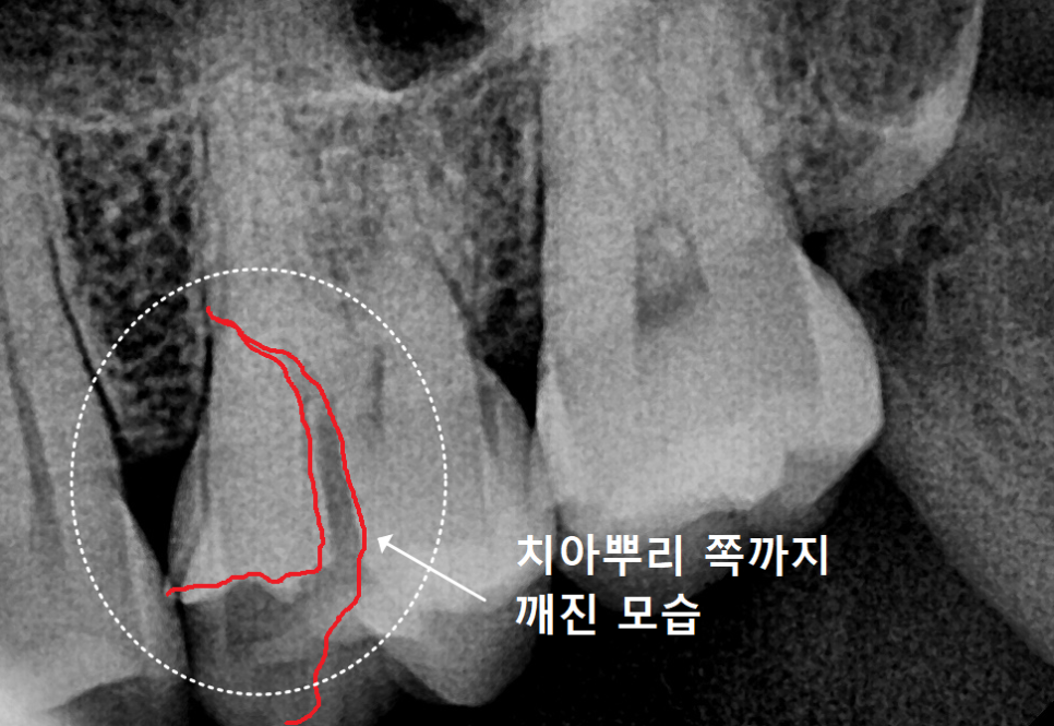 크라운 탈락 빠짐, 빠졌을 때 그대로 다시 붙일 수 있나요? 관련 이미지 6