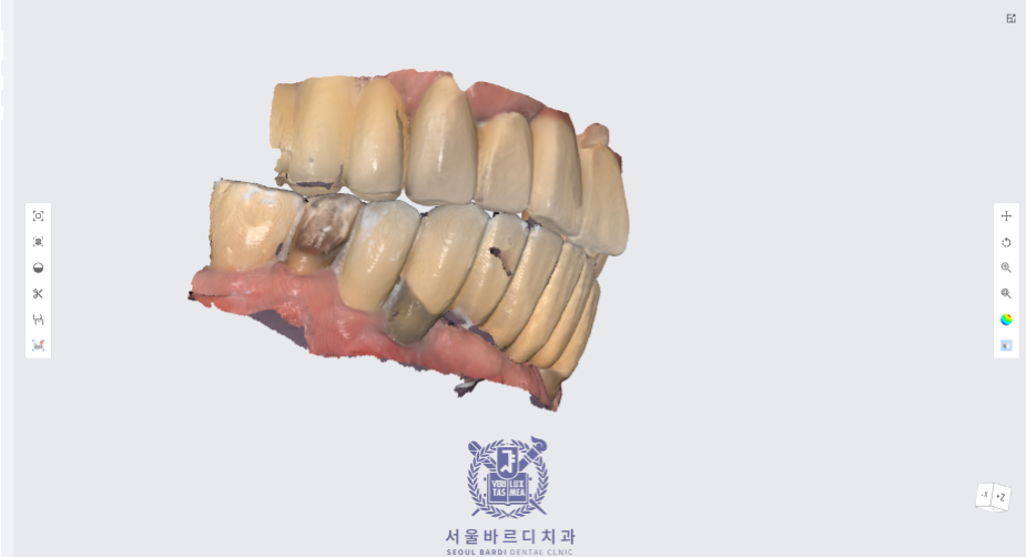 고덕동치과 서울바르디치과 전치부 및 구치부 임플란트 치료증례 #10 관련 이미지 5