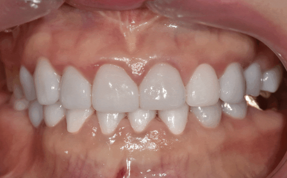 누런 치아 연예인치아 처럼 하얗게 만들 수 있나요? 관련 이미지 1