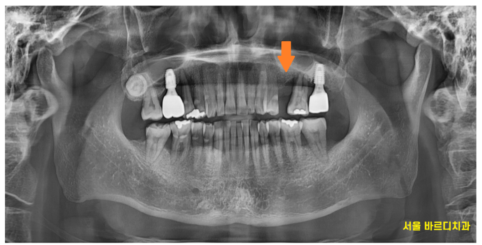 상일동 치과 잇몸 내려감 치료는 임플란트로 관련 이미지 2