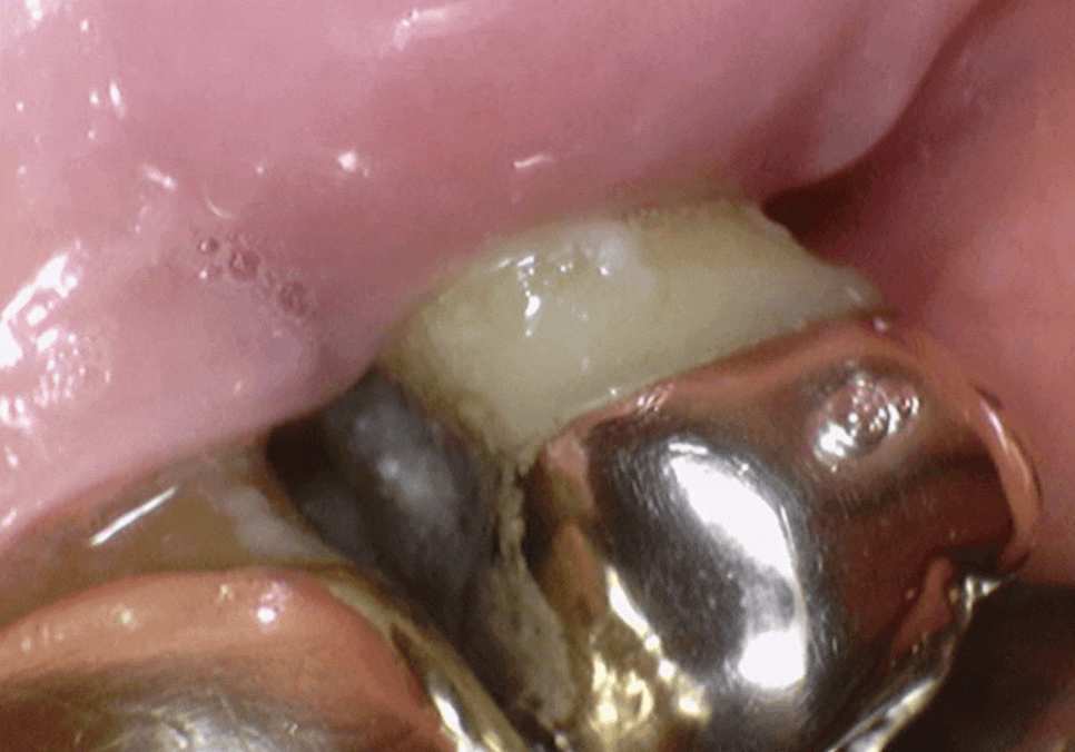 강동구 잇몸 퇴축으로 뿌리 드러난 치아, 이대로 둬도 괜찮을까? 관련 이미지 5