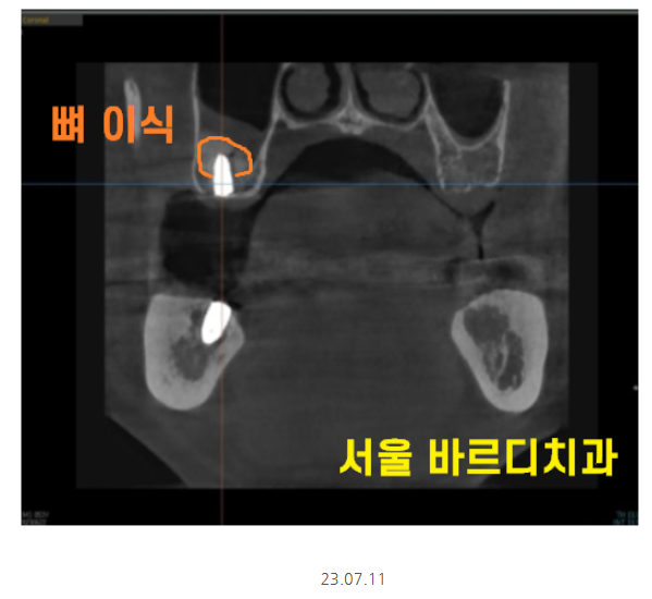 명일동 치과 임플란트 위아래 같이 할 수 있나요?? 관련 이미지 5