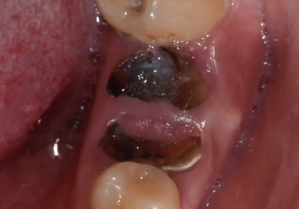A Single Black Spot of Decay Between the Front Teeth May Be a Warning Sign of Multiple Cavities. image 4