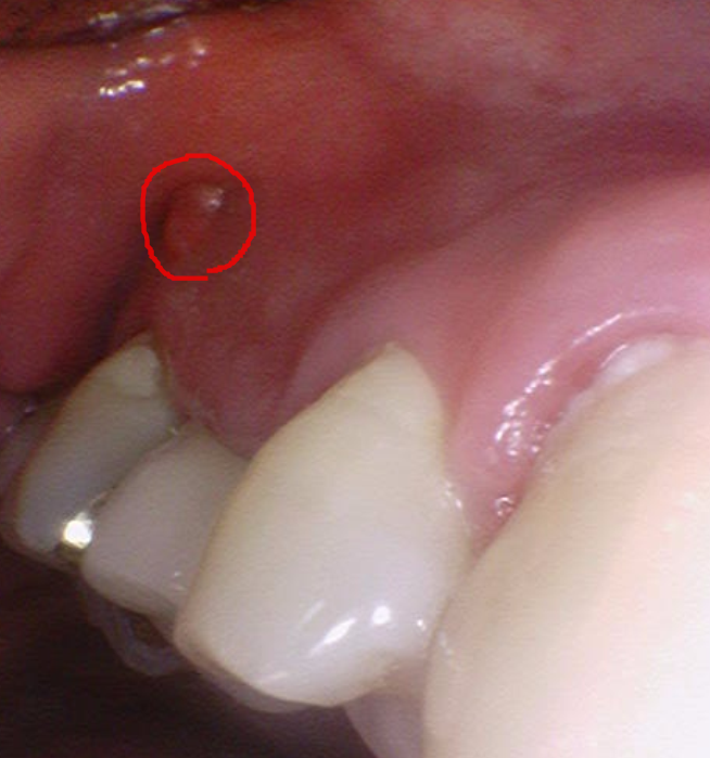 하남시청치과 신경치료 치아 발치 후 임플란트 했습니다. 관련 이미지 3