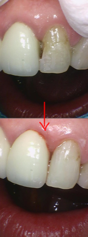 미사역 치과 앞니 충치 레진으로 당일 수복 완료하였습니다. 관련 이미지 7