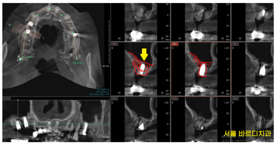 명일동 치과 임플란트 치료 기간 얼마나 걸릴까요??? 관련 이미지 6