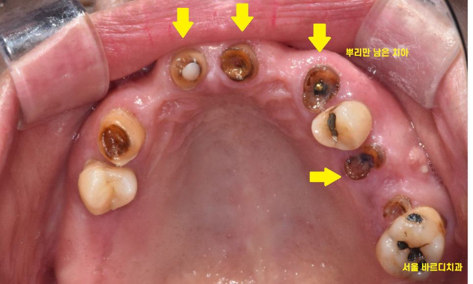 암사동 치과 전악 임플란트 하루만에 끝냈습니다. 관련 이미지 3