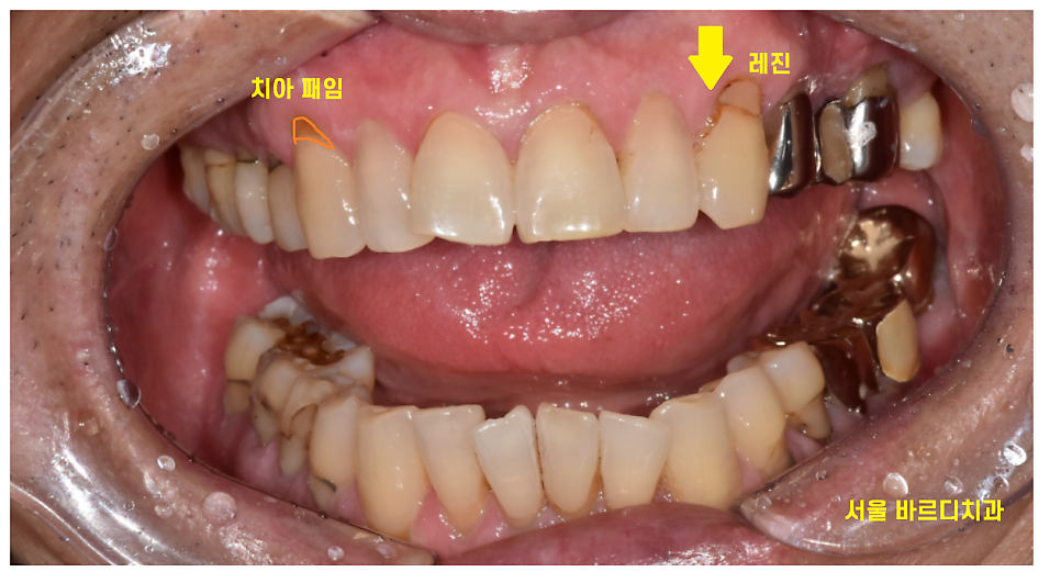 충치치료 레진 비용 이 금액이 맞나 궁금하신 분들을 위하여 관련 이미지 2