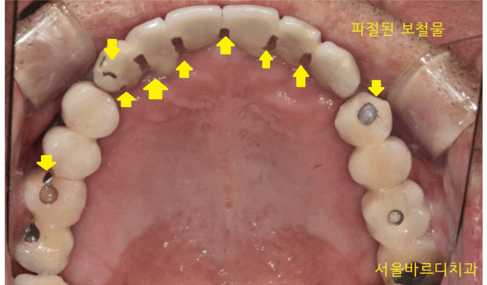 덕풍동 치과 오래된 임플란트 제거 후 재식립하였습니다. 관련 이미지 1