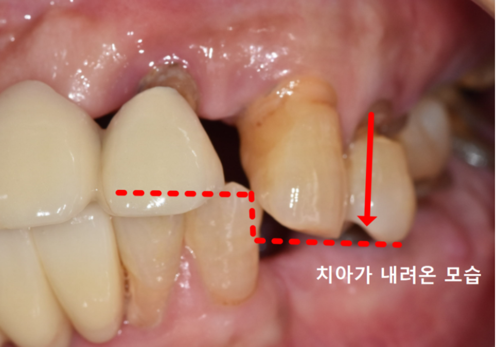 흔들리는 치아 묶어두는 잠간고정술, 오히려 잇몸뼈를 녹일 수도 있다고요? 관련 이미지 2
