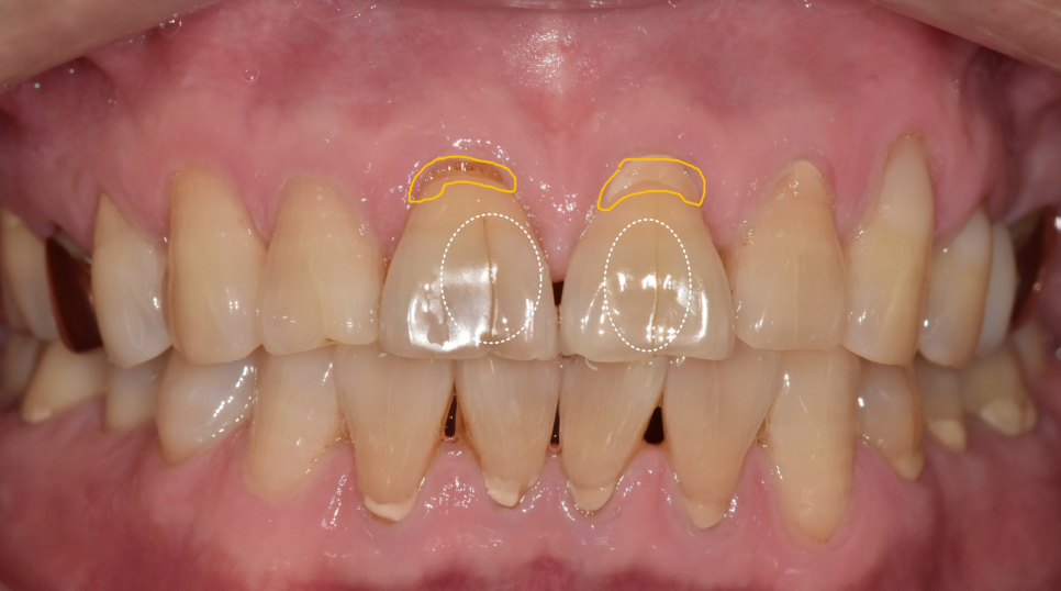 앞니 금 갔을 때, 방치하면 안 되는 진짜 이유 <파절 치료 사례> 관련 이미지 7