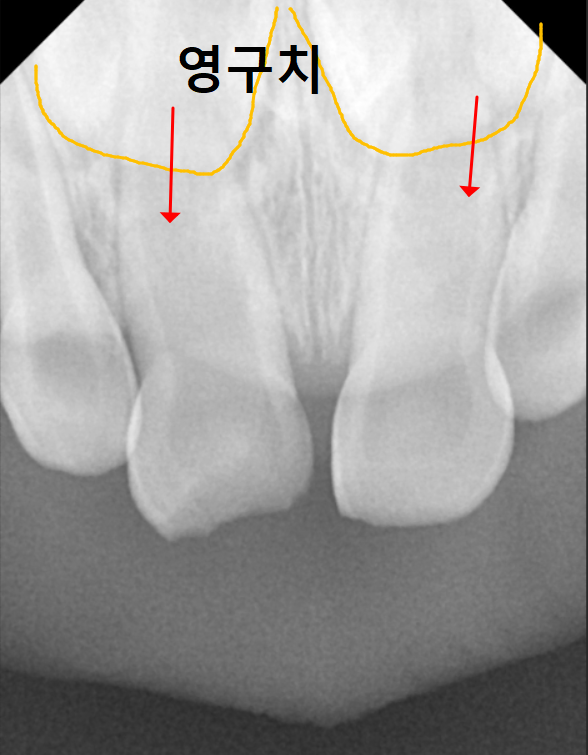 흔들리는 성인 잔존 유치, 50년 만에 송곳니 임플란트 하게 된 사연 관련 이미지 1