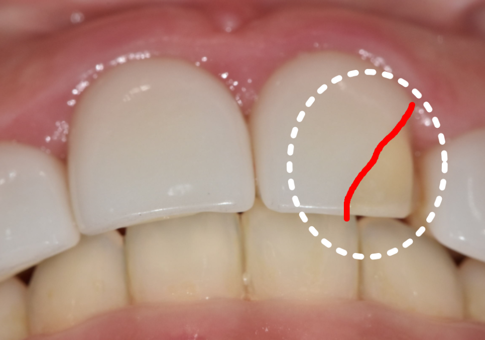 앞니 덧니, 교정은 싫고 시간은 없다면? 라미네이트로 해결한 사례 관련 이미지 3