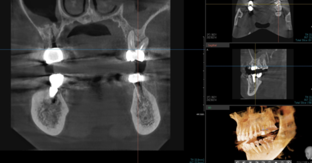 미사역 임플란트 상악동염으로 치아를 발치한 사연 관련 이미지 5