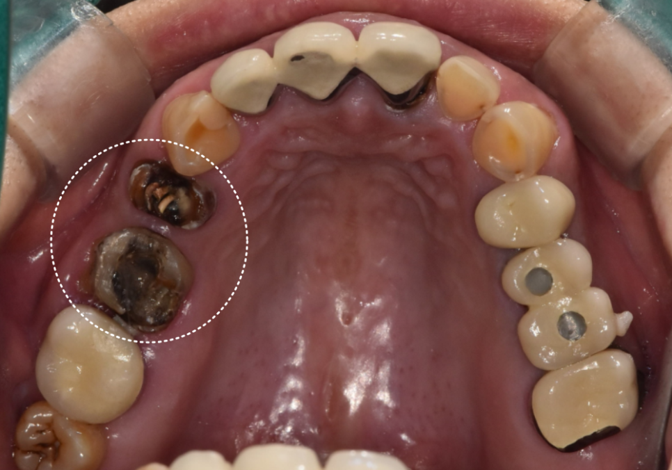 강동구 오래된 보철, 교체 시기는? 아프지 않은데 꼭 바꿔야 하나요? 관련 이미지 7
