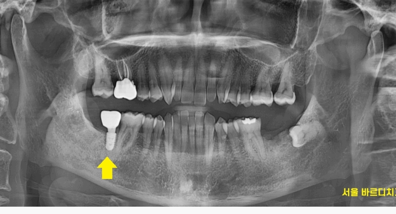 하남시청치과 내비게이션 임플란트 뭐가 좋아요?? 관련 이미지 1