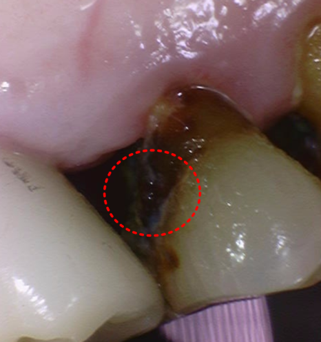 상일동 임플란트 심한 충치로 인한 치아 부러짐 해결한 사례 관련 이미지 10