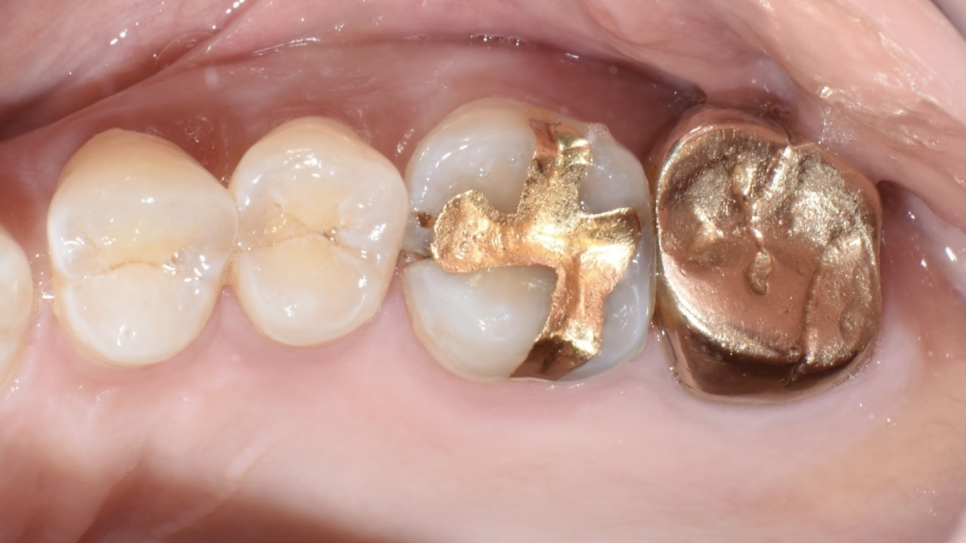 골드 인레이 하방 이차우식 => E.max 인레이로 재치료 케이스 관련 이미지 1