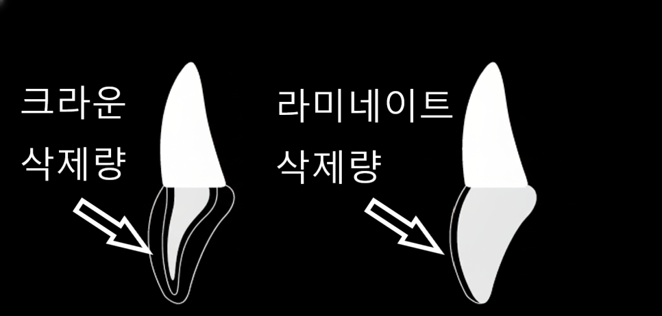 고덕동 치간 이개, 위 앞니 벌어짐, 교정? 라미네이트? 고민이시라면 필독 관련 이미지 8