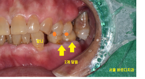망월동 치과 어금니 빠짐 임플란트 대안이 될 수 있습니다. 관련 이미지 4