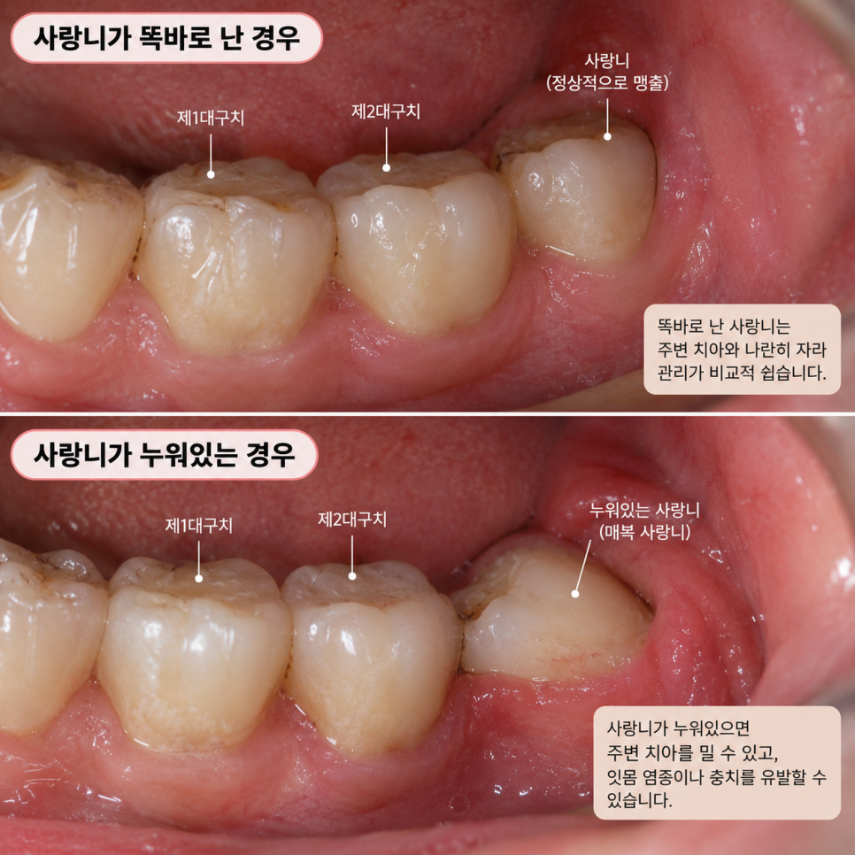 사랑니 발치 시기, 언제 빼야 유리할까? 관련 이미지 2