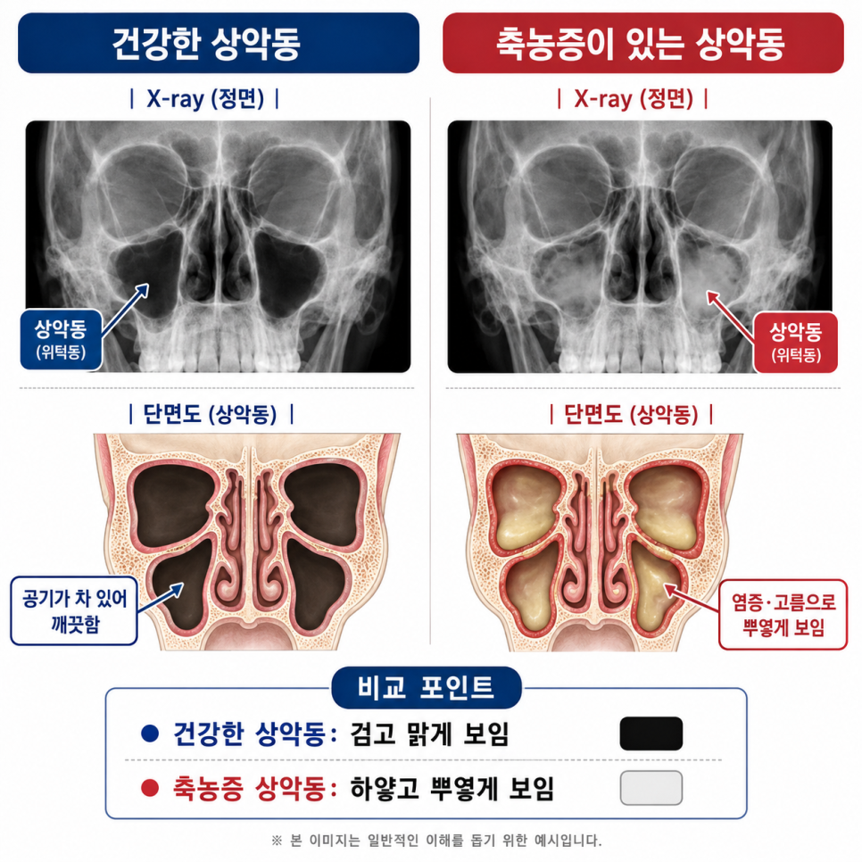 한쪽 코만 막히는 축농증, 원인이 코가 아닐 수 있습니다 관련 이미지 2