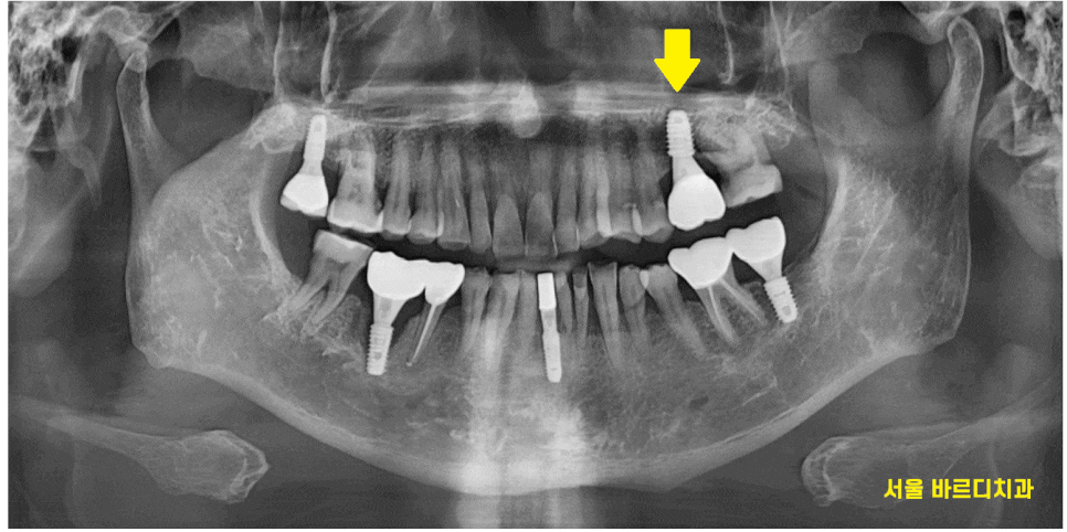 하남 치과 임플란트 질문 폭격기를 환영합니다. 결정은 자유롭게! 관련 이미지 1