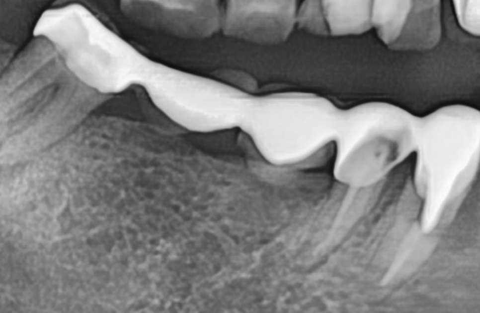 오래된 어금니 롱브릿지, 교체 타이밍을 놓치면 관련 이미지 2