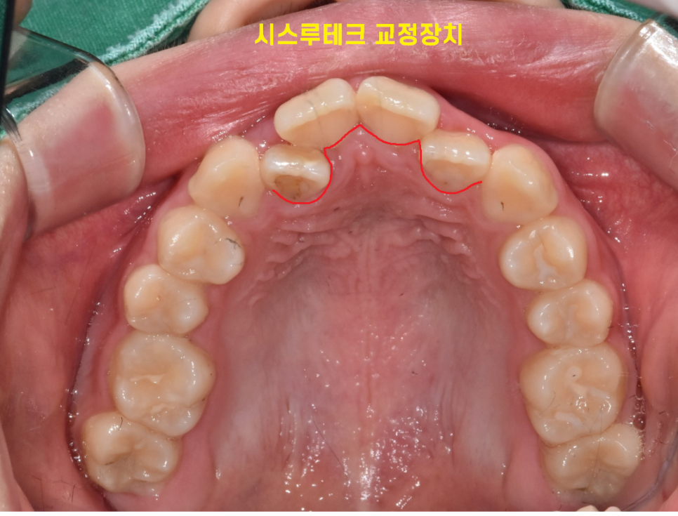 투명교정 장치 종류 인비절라인과 시스루테크 어느 것이 좋을까요? 관련 이미지 5