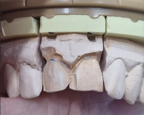 앞니 덧니, 교정은 싫고 시간은 없다면? 라미네이트로 해결한 사례 관련 이미지 8