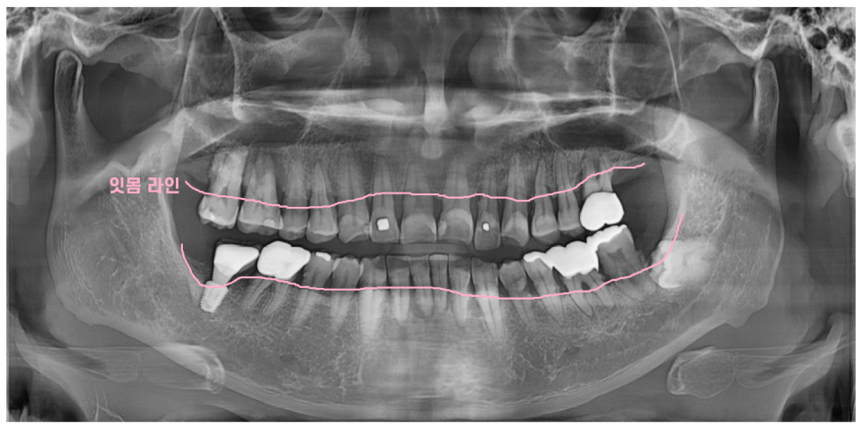 잇몸 주저앉음 발치하게 되는 제일 큰 원인이기에 잇몸치료 과정 공개 관련 이미지 3