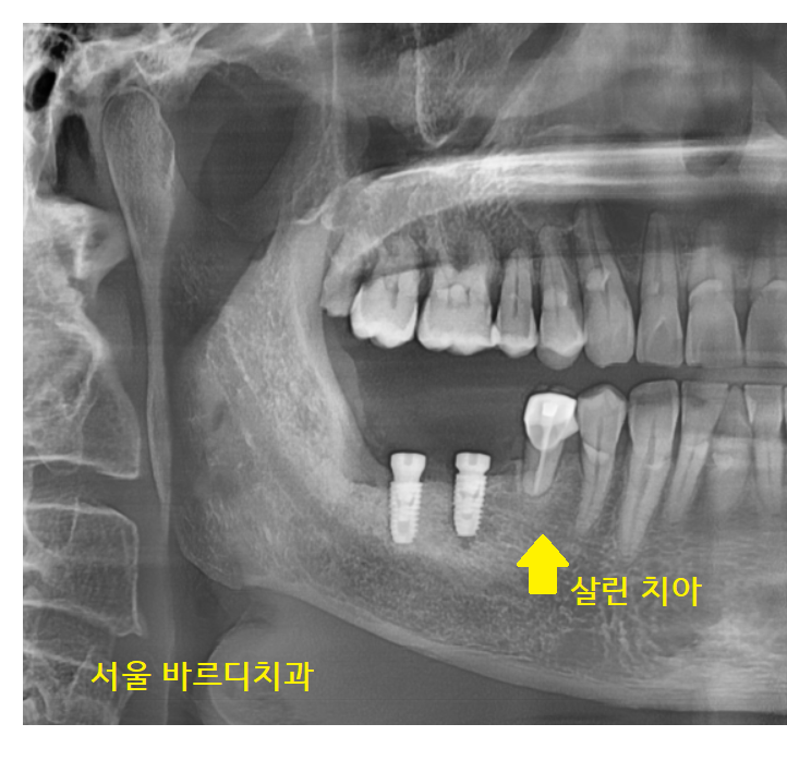 강일역 치과 치아와 임플란트 연결 가능한가요??? 관련 이미지 6