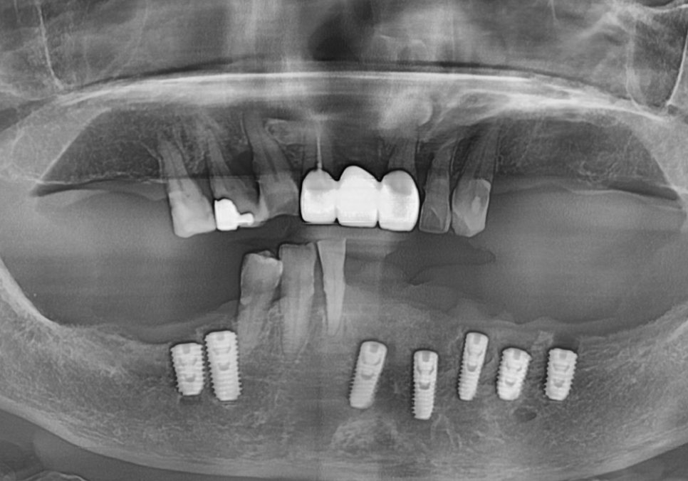 천호 디지털 가이드 임플란트, 일반 임플란트와 무슨 차이가 있나요? 관련 이미지 10