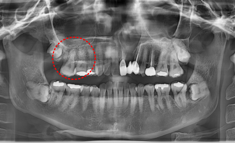 치아 뿌리 염증 빼야 된다는 치아, 이렇게 살렸습니다. 치료 방법 관련 이미지 1