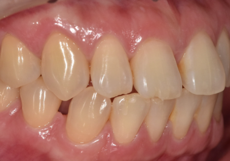 무삭제 라미네이트 적응증, 당신이 미처 몰랐던 시술의 조건을 공개합니다. 관련 이미지 8