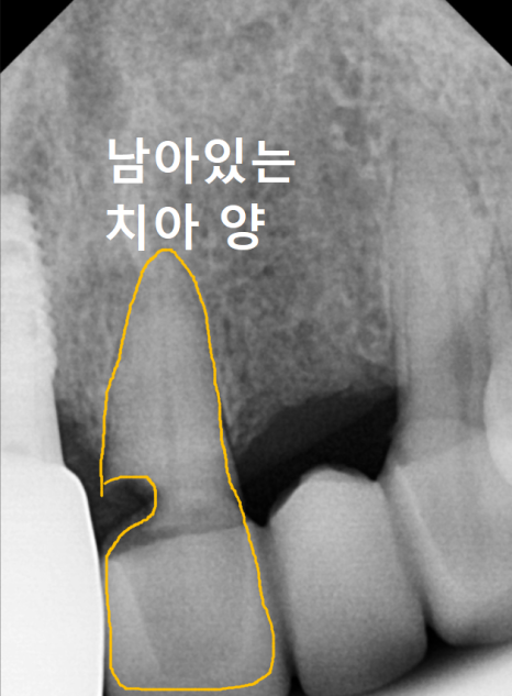 음식물 끼임, 거뭇한 무언가 보인다면? 이미 늦었을 수 있습니다. 관련 이미지 7