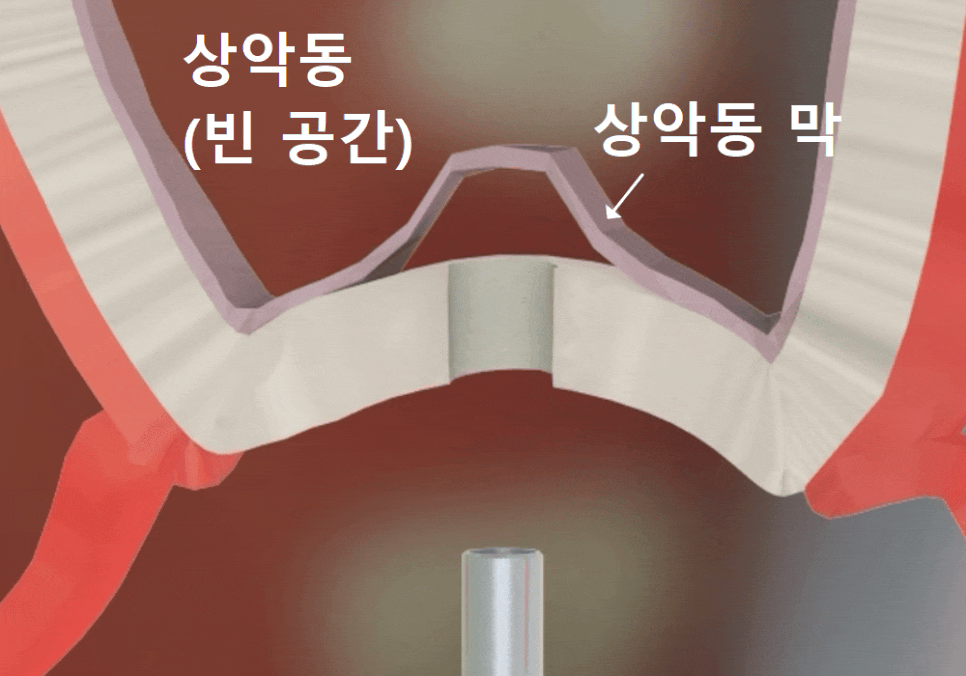 뼈가 없어서 안 된다구요? 70대 당뇨 무치악 환자분의 전체 임플란트 사례 관련 이미지 6