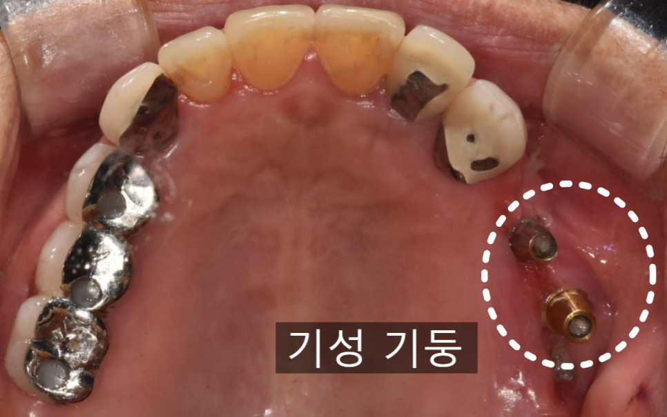 고덕동치과, 보험 임플란트? 추가 비용이 왜 나오는 거죠? 관련 이미지 5