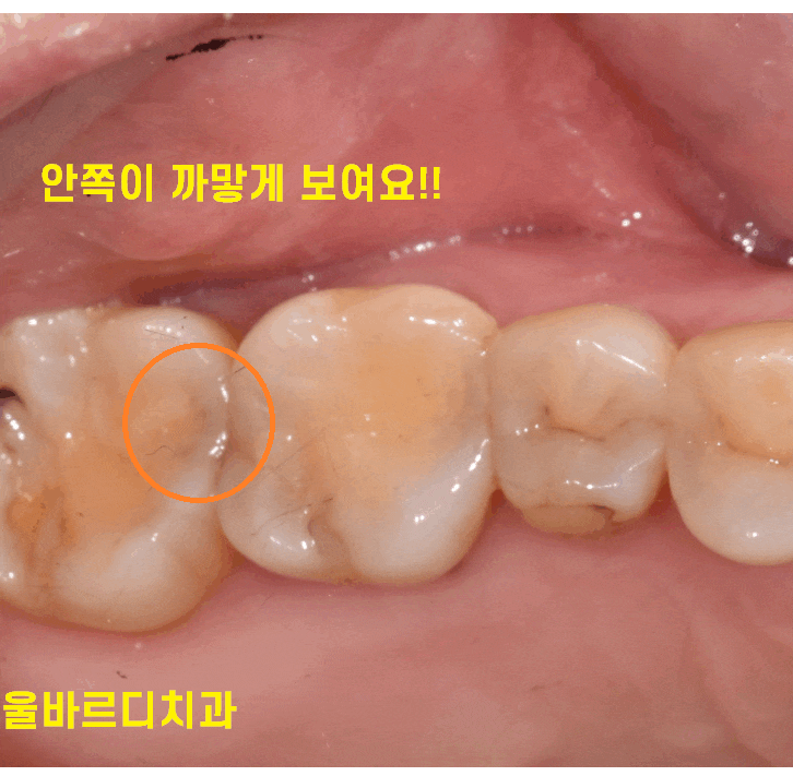 치실 안쓰면 이렇게 됩니다!!  치아 사이 충치 인레이 치료 관련 이미지 1