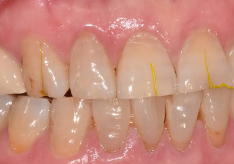 고덕동 앞니 보철, 브릿지와 싱글 크라운, 어떤 선택이 나에게 더 유리할까? 관련 이미지 7