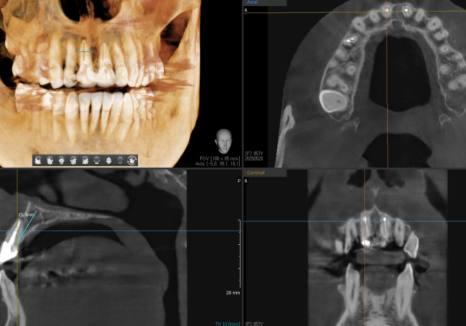 잇몸 까매짐 원인,증상,치료 방법 오래전에 앞니 씌운 곳 잇몸이 까매졌어요. 관련 이미지 7