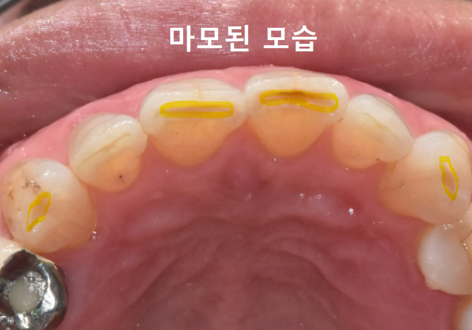 고덕동 앞니 보철, 브릿지와 싱글 크라운, 어떤 선택이 나에게 더 유리할까? 관련 이미지 8