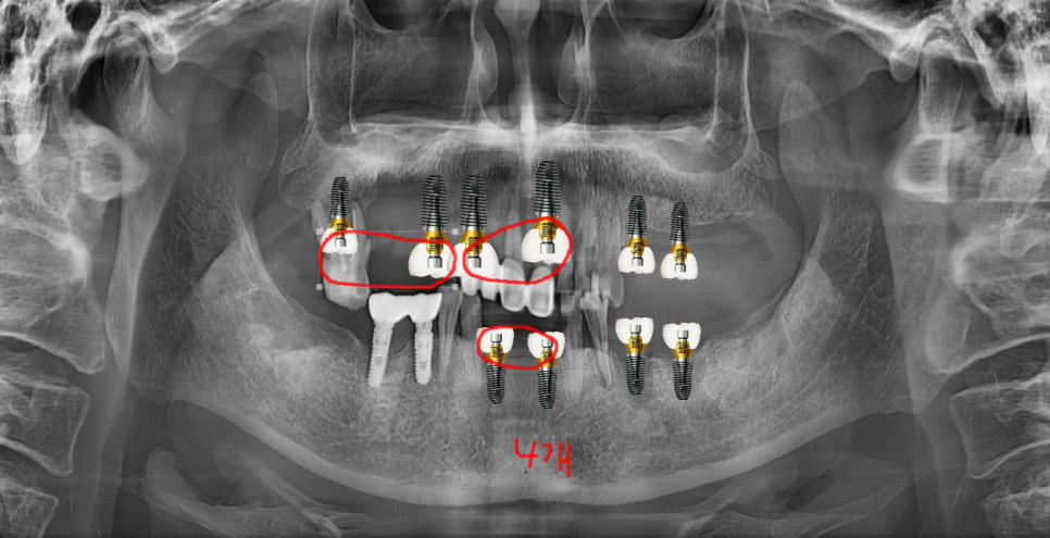 천호동 치과 자연 발치 후 방치된 치아 임플란트 케이스 관련 이미지 7